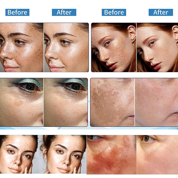 Dark Spot Remover for Face, Hyperpigmentation Treatment, Melasma, Freckle, Sun Spots Removal for All Skin Types Dark Spot Corrector for Men and Women