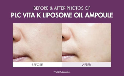 Dr.Ceuracle PLC Vitamin K Liposome Oil Ampoule - Korean Vitamin K Face Serum for Evening Skin Tone and Relieving Imperfections (50 ml / 1.69 fl. oz.)