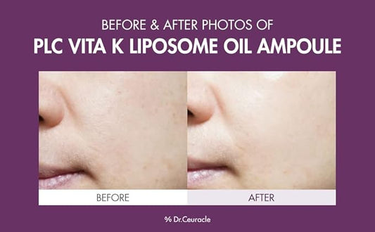 Dr.Ceuracle PLC Vitamin K Liposome Oil Ampoule - Korean Vitamin K Face Serum for Evening Skin Tone and Relieving Imperfections (50 ml / 1.69 fl. oz.)