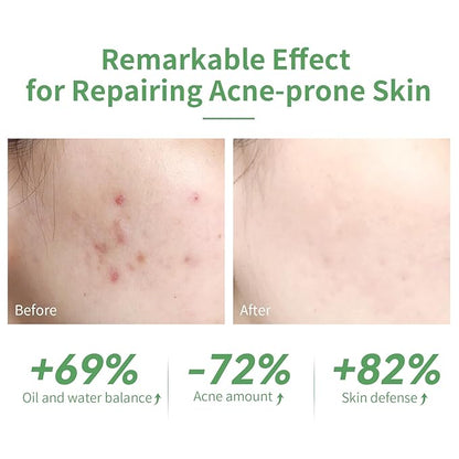 10% Salicylic Acid Serum, Acne Treatment for Face, 15ml/0.5oz, Minimize Pores, Active Skin Repair, Relieve Redness Blemish, Pimples Remover, Skin Barrier Repair for Acne Prone Sensitive Skin Care