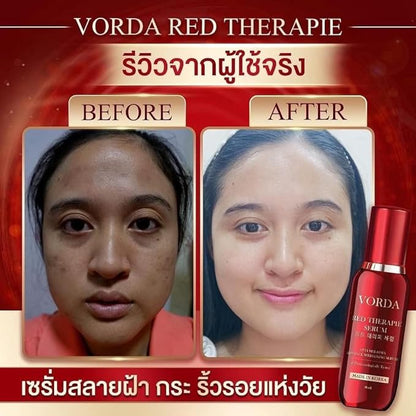 Vorda Red Therapie Serum Facial 30ml Made In Korea X50 Photoglow