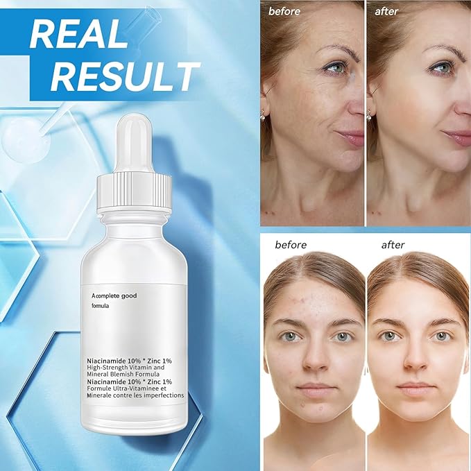 10% Niacinamide + 1% Zinc Face Serum, Nourishing & Refreshing Facial Serum ， Women Serum for Oil Control and Acne 30ML/1 Fl Oz