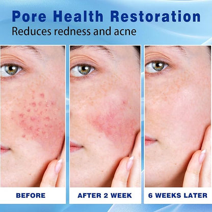 10% Azelaic Acid Acne Cream, Premium Azelaic Acid Facial Cream - Redness Relief For Face, Redness Reducing Skin Care, Prevents Acne Breakouts, Ease Pimple Clarify Skin Soothe Irritation,1 Oz