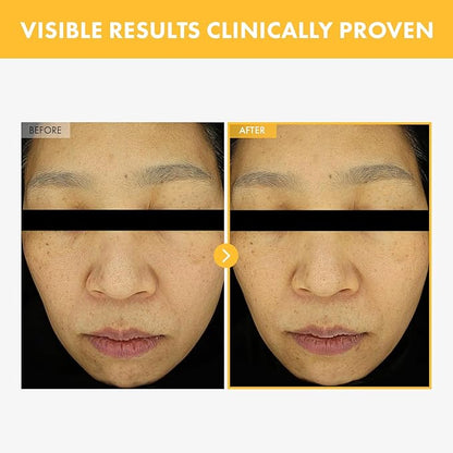 8 Days Spot Cream, Dark Spot Remover for Face, Age Spot, Sun Spot, Freckles, Melasma, Brown Spot Serum, Advanced Formula Corrector Cream with Niacinamide for Women and Men, 50g, 1.76 oz.