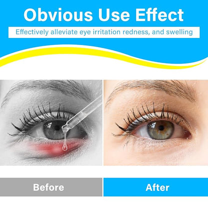 Stye Eye Treatment, Natural Stye Treatment Serum for Styes Chalazion and Blepharitis, Mild & Fast Relief