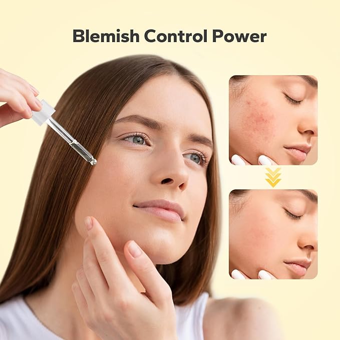 10% Azelaic Acid Serum (1 Fl Oz), Niacinamide Infused Skin Care for Face, Pore Minimizing, Redness Relief, Reduce Cystic Acne Scar, Blemish Control Serum