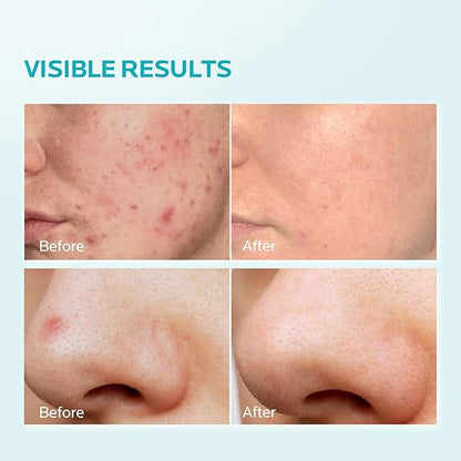 ZealSea Azelaic Acid 10% Facial Cream for Redness Relief Face Skin Care, Pimple Pigmentation Blackhead, Balance Excess Sebum, Clarify Skin, Soothe Irritation,1 Oz, Pack of 2