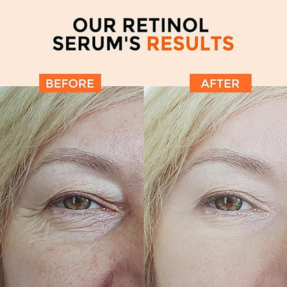 Retinol Serum for Face 2.5%, B5 Resurfacing Retinol Serum with Vitamin C, Vitamin E, Hyaluronic Acid, Niacinamide, Serum for Anti-Aging, Wrinkle Smoothing, Dark Spot Corrector, Brighten Dullness